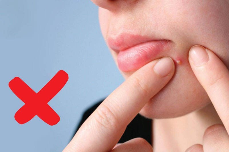 Một số loại mụn không nên tự nặn để tránh gây nguy hiểm